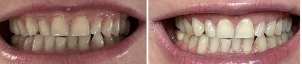 Product Image and Link for Teeth Whitening Service